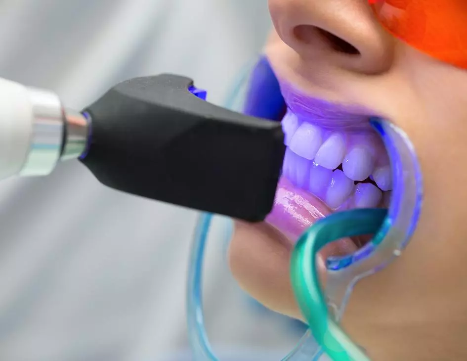 Tooth Whitening - Private Eliz Dent Oral and Dental Health Polyclinic