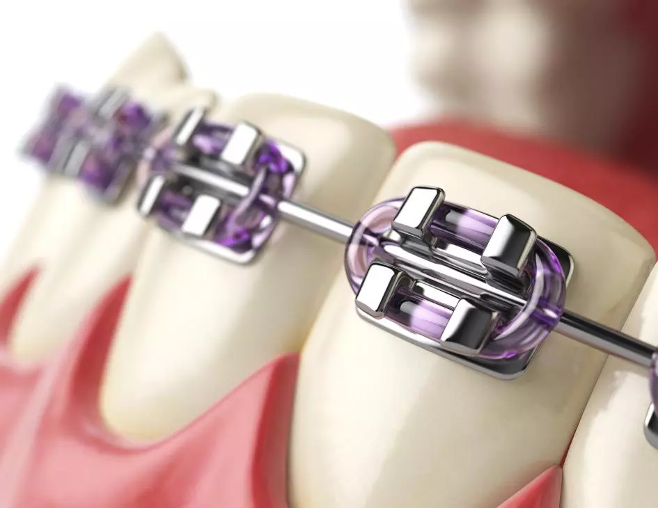 Orthodontic Treatment - Private Eliz Dent Oral and Dental Health Polyclinic