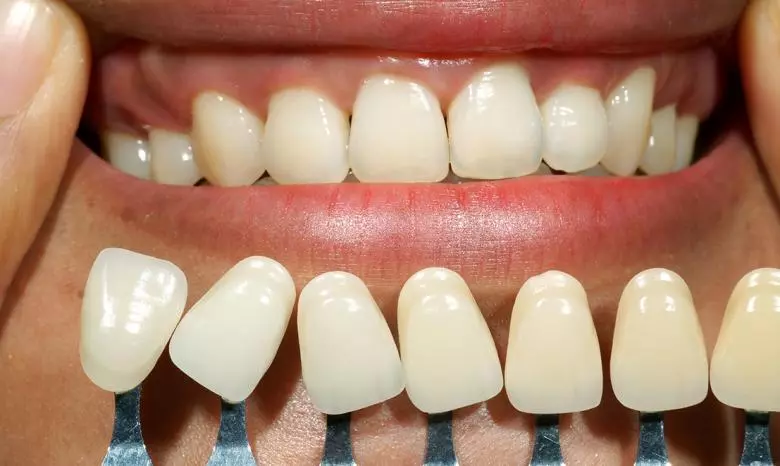 Diş Beyazlatma (Bleaching) Nedir? - Özel Eliz Dent Ağız ve Diş Sağlığı Polikliniği