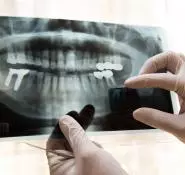 Kanal Tedavisi Nedir? - Özel Eliz Dent Ağız ve Diş Sağlığı Polikliniği