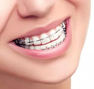Ortodonti Tedavi Nedir? - Özel Eliz Dent Ağız ve Diş Sağlığı Polikliniği