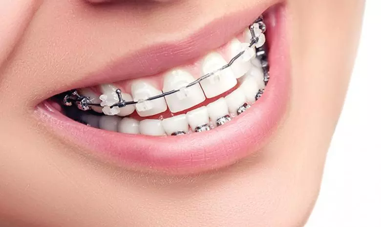 Ortodonti Tedavi Nedir? - Özel Eliz Dent Ağız ve Diş Sağlığı Polikliniği