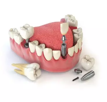 Dental Implants - Private Eliz Dent Oral and Dental Health Polyclinic