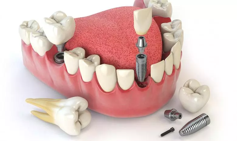 Dental Implants - Private Eliz Dent Oral and Dental Health Polyclinic