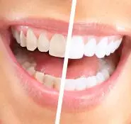 Tooth Whitening - Private Eliz Dent Oral and Dental Health Polyclinic