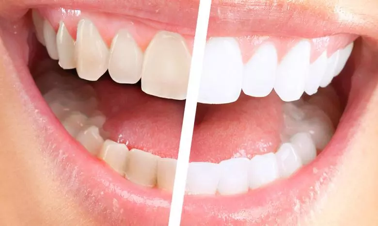 Tooth Whitening - Private Eliz Dent Oral and Dental Health Polyclinic