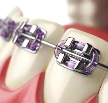 Orthodontics - Private Eliz Dent Oral and Dental Health Polyclinic