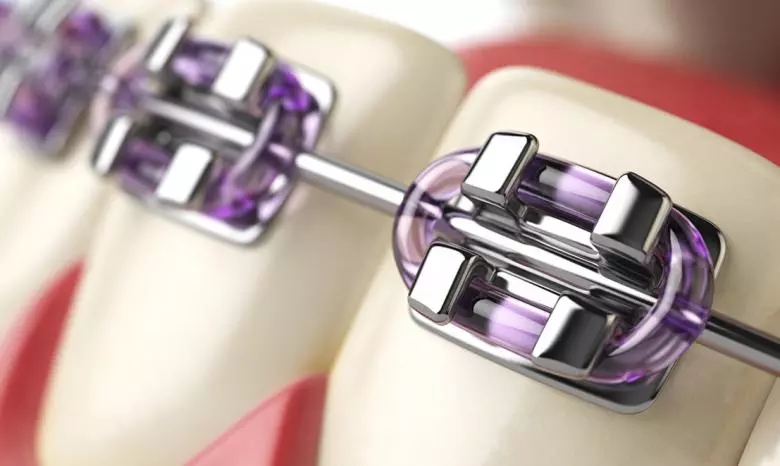 Orthodontics - Private Eliz Dent Oral and Dental Health Polyclinic