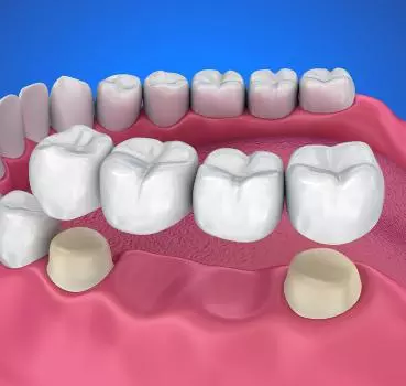 Porcelain Crowns and Bridges - Private Eliz Dent Oral and Dental Health Polyclinic