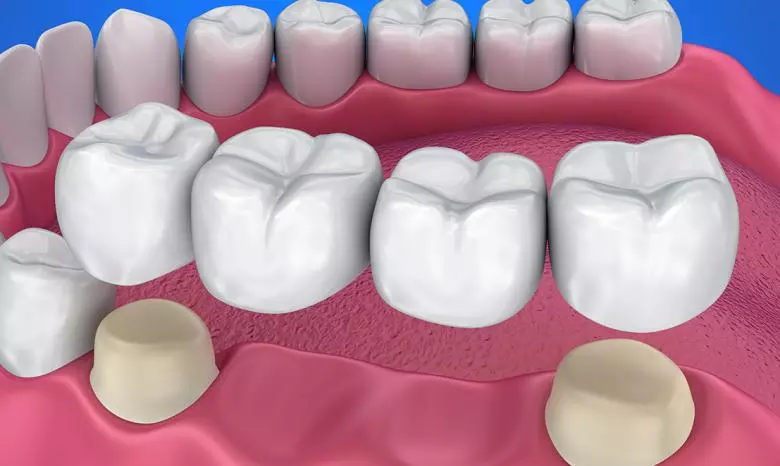 Porcelain Crowns and Bridges - Private Eliz Dent Oral and Dental Health Polyclinic
